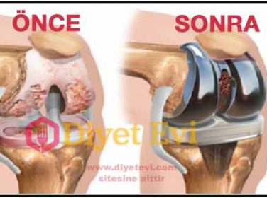 Eklem-diz-agrilarini-geciren-dogal-tedavi-yontemi-376x280[1]