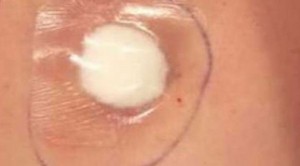 Göbek-çukuruna-alkollü-pamuk-koymak-300x166[1]