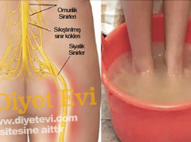 10-dakikada-siyatik-agrisi-tedavisi-376x280[1]