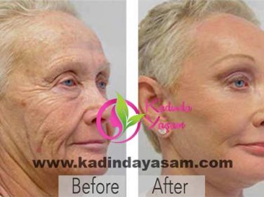 Aspirin-yaslanma-karsiti-soyma-maskesi-376x280[1]